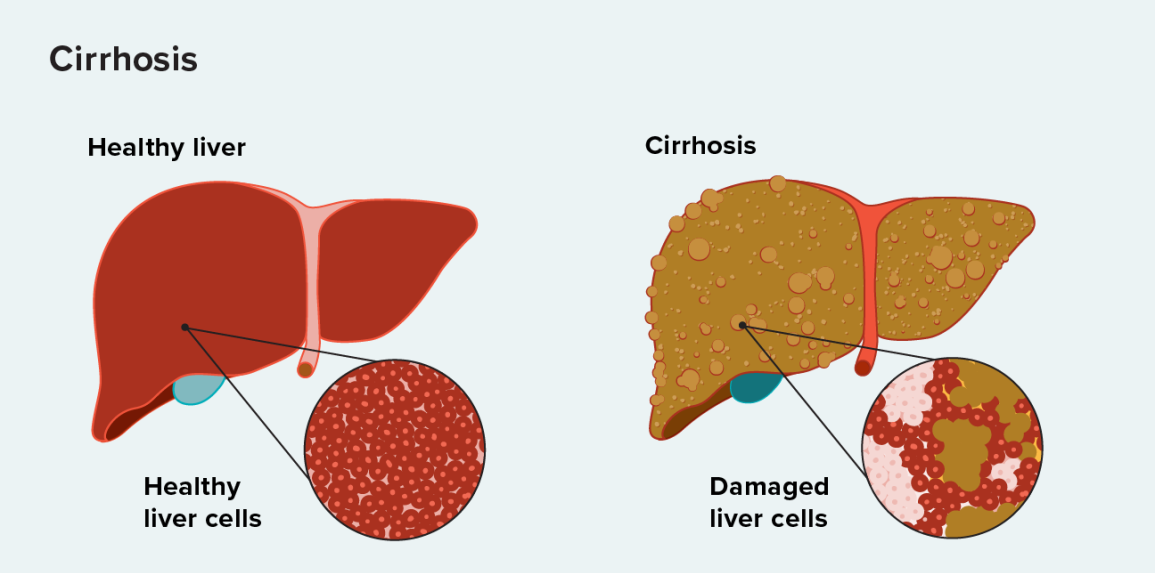 Liver Health - Cirrhosis