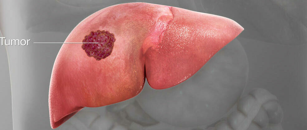 Liver Health - Liver Cancer image